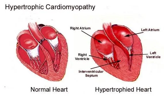 Esquema de un corazon normal y de uno con miocardiopatia hipertrofica