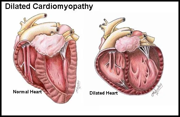 Esquema de un corazon normal y de uno con miocardiopatia dilatada